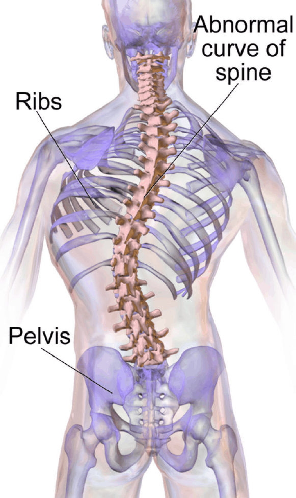 scoliosis