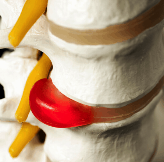 cause of degenerative disc disease