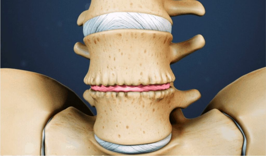 degenerative disc disease