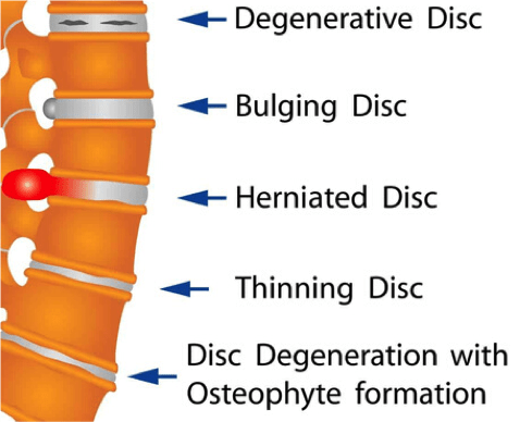 slipped disc