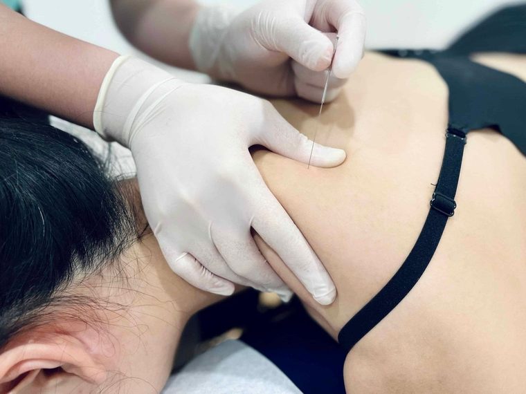 Dry needling being performed on a patient
