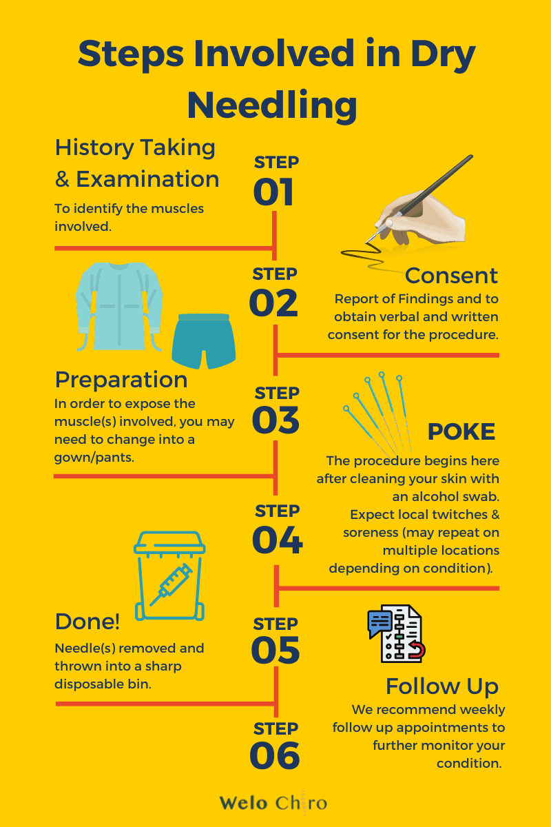 All you need to know about Dry Needling under 2 minutes! Welo Chiro